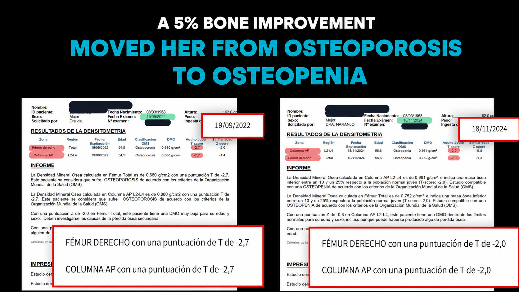 Luisa improved 45%, going from osteoporosis to osteopenia